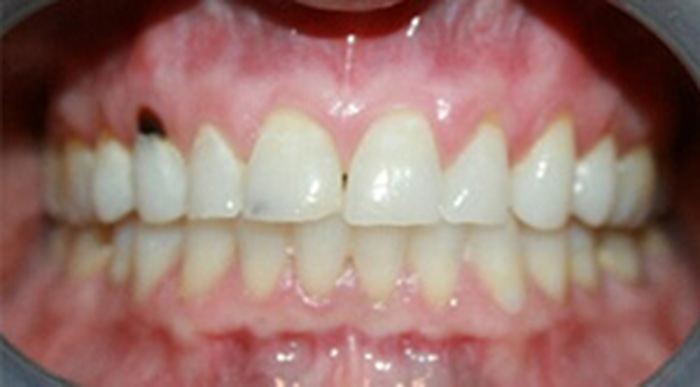 Composite Fillings Jacksonville Fl Dentists