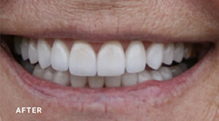 Cosmetic Dental Crown Dentists Near Me