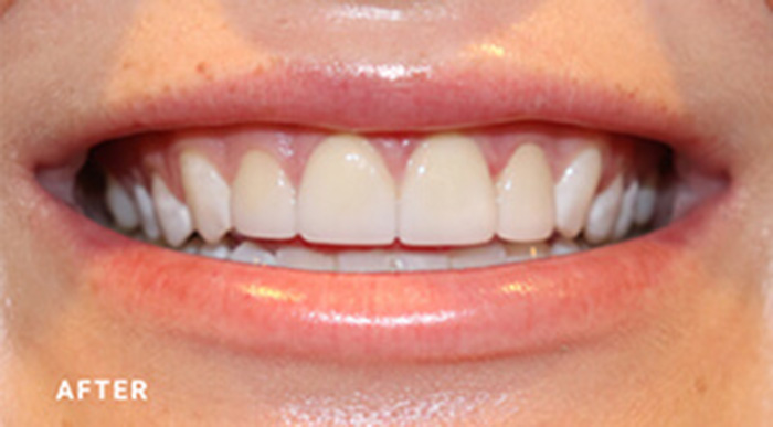 Cosmetic Porcelain Crown Dentists Near Me