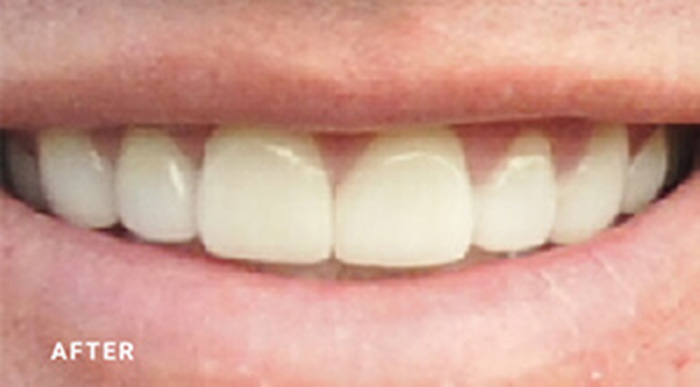 Cosmetic Porcelain Veneer Dentist Near Me