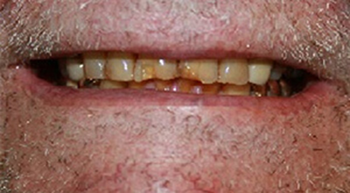 Dental Implant And Crown Dentist Jacksonville