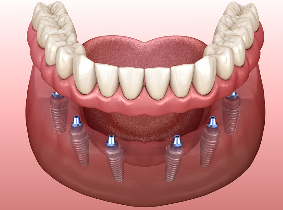 Implant Supported Dentures Jacksonville Florida