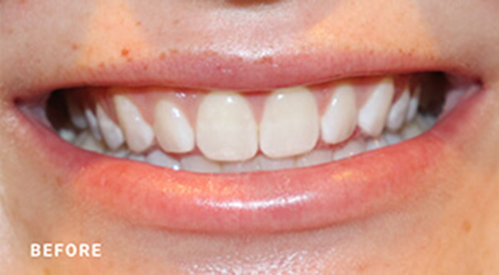 Jacksonville Cosmetic Porcelain Crown Dentists