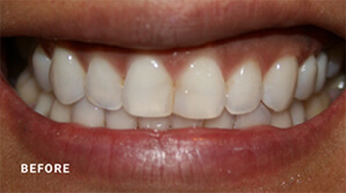 Jacksonville Porcelain Crown Dentists