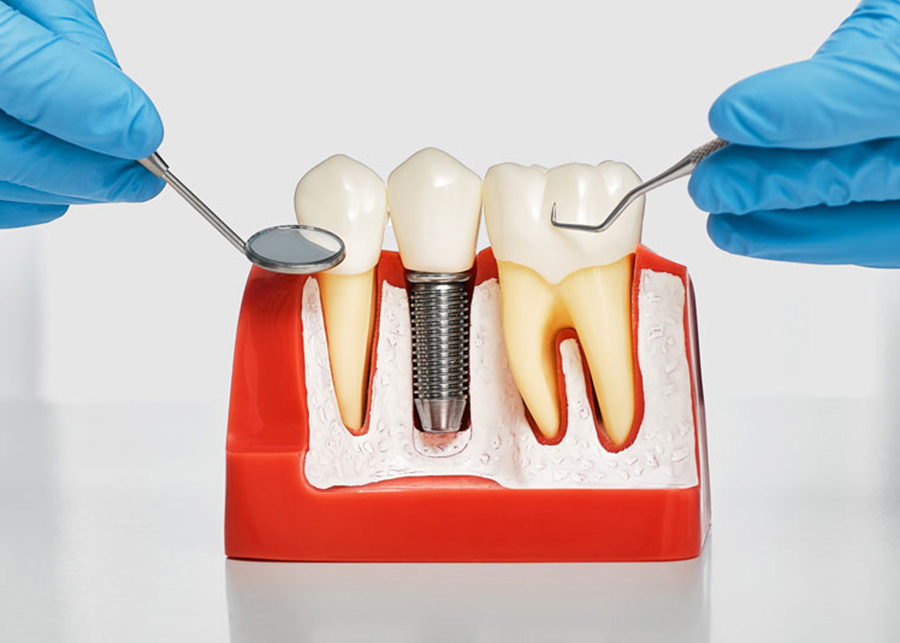 Dental Implants Dentist Florida