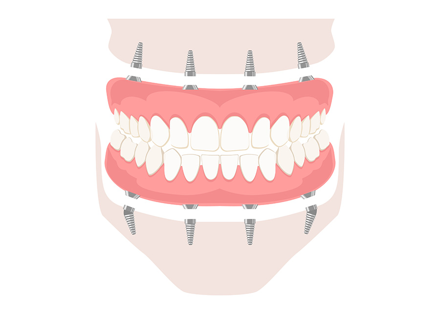 Full Arch Dental Implants Jacksonville Dentist