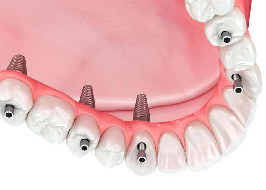 Jacksonville Florida Dental Implant Provider