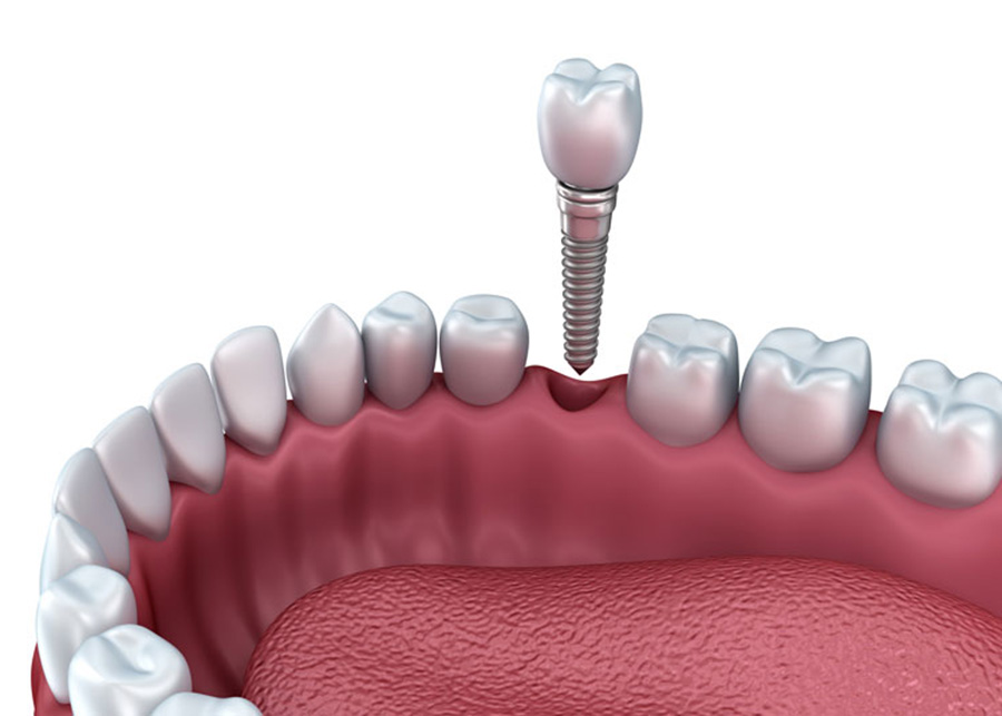 Jacksonville Florida Dental Implants Dentists