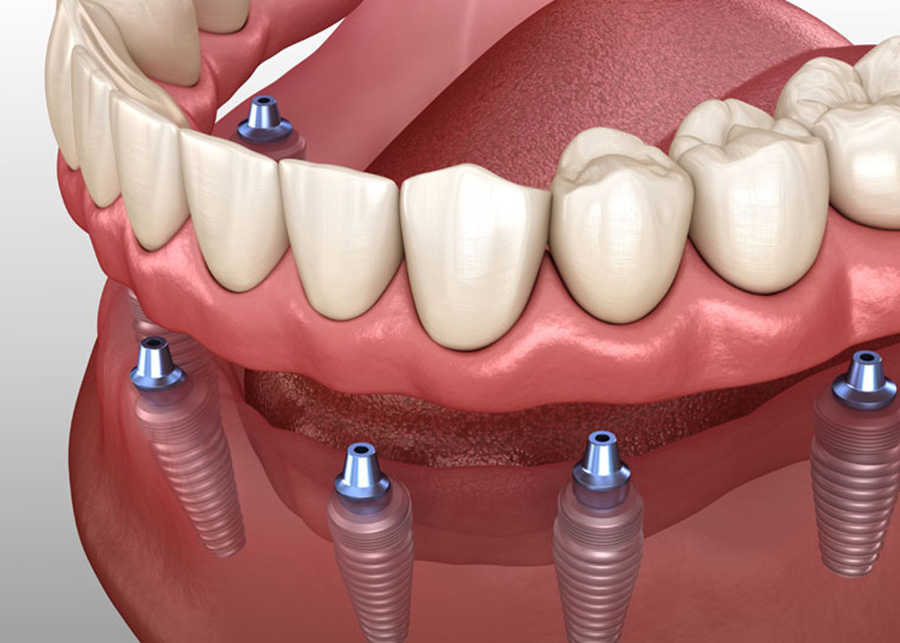 Jacksonville Florida Implant Supported Dentures Dentist