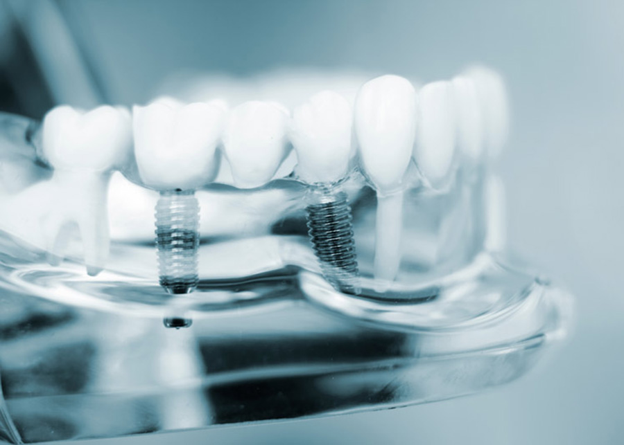 Multiple Dental Implant Procedure Dentist Near Me