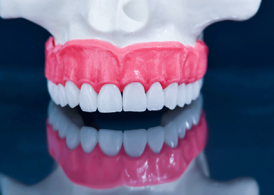 Types Of Dental Implants Jacksonville Florida Dentist