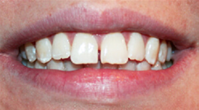 Clear Aligners Dentists Near Me