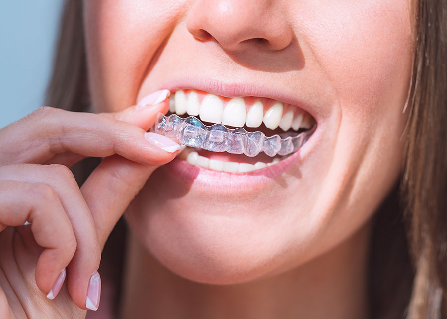 Jacksonville Florida Clear Aligners Dentist