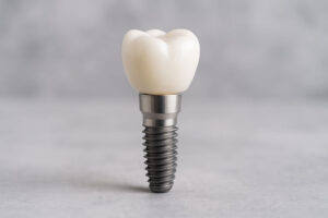 Single Dental Implant
