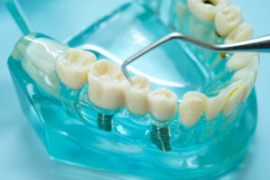 Dental Implants Clear Jaw