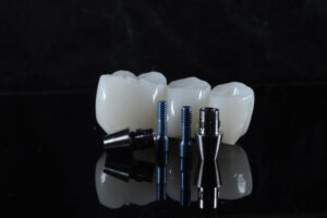 Dental Implant Bridge
