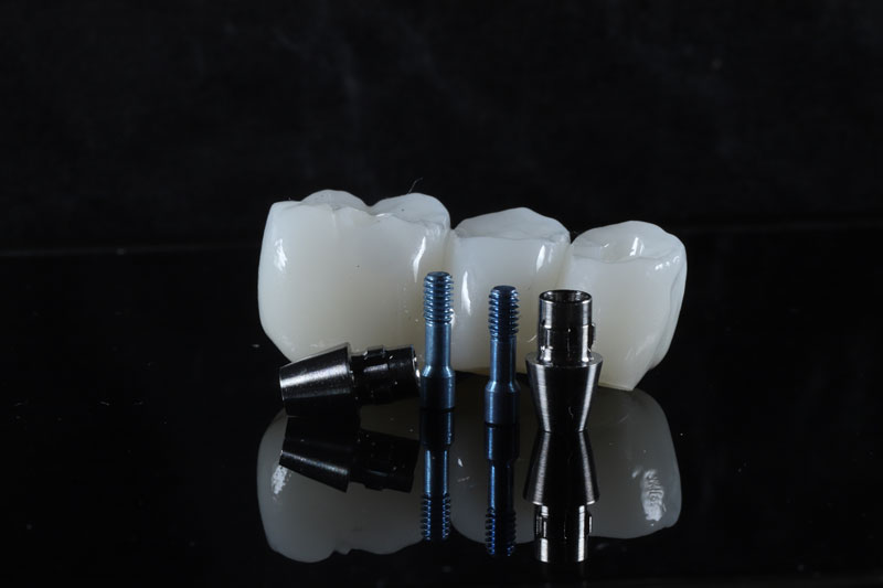 Dental Implant Bridge