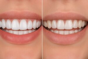 An image displaying two sets of teeth side by side, one labeled "Porcelain Veneers" with a bright, natural-looking smile, and the other labeled "Composite Veneers" with a smile that appears slightly duller. No text on the image.