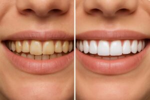 A split image showing before-and-after results of veneers. The "before" side shows teeth with discoloration and minor imperfections, while the "after" side showcases a bright, uniform smile achieved with veneers. No text on the image.