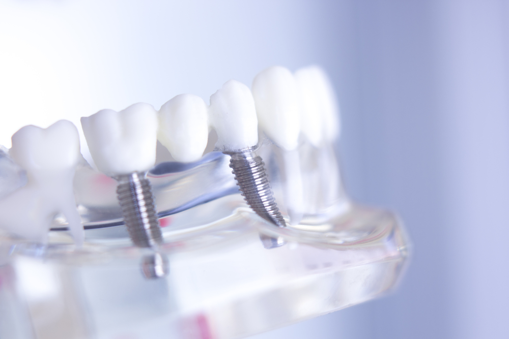 Dentist discussing dental implant and denture options with patient in modern clinic